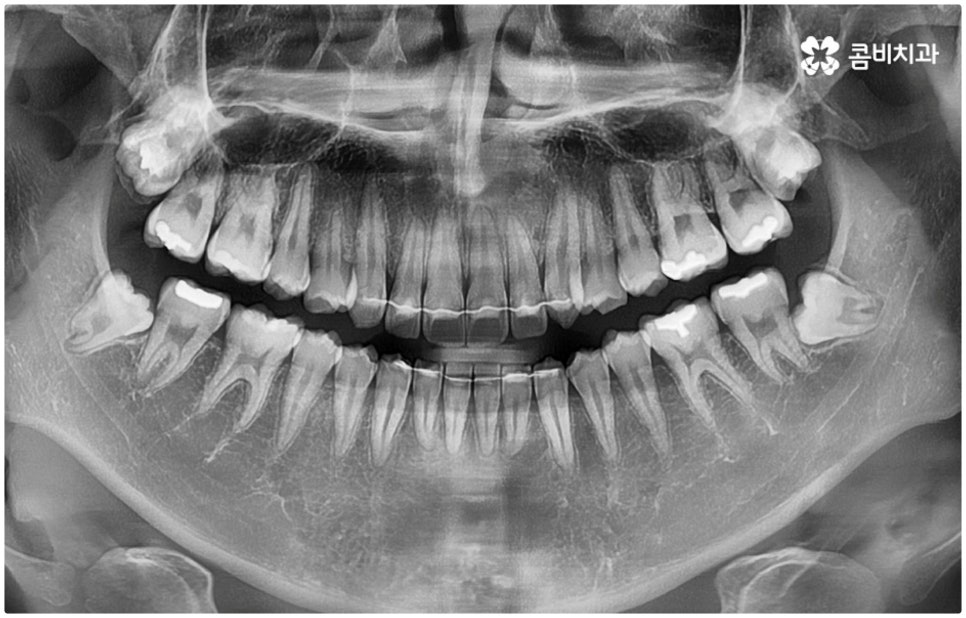 매복사랑니발치치과 어디로 가나요? 관련 이미지 9