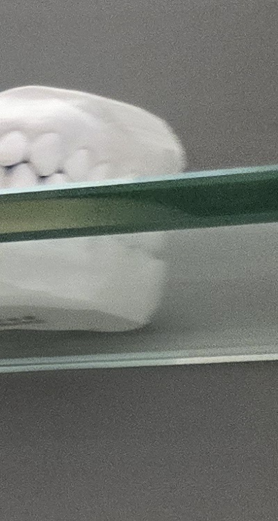 윗니 전체 임플란트 뭐부터 해야할까 관련 이미지 17