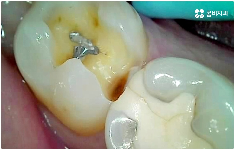 명동치과 평소에 케어하기 관련 이미지 7