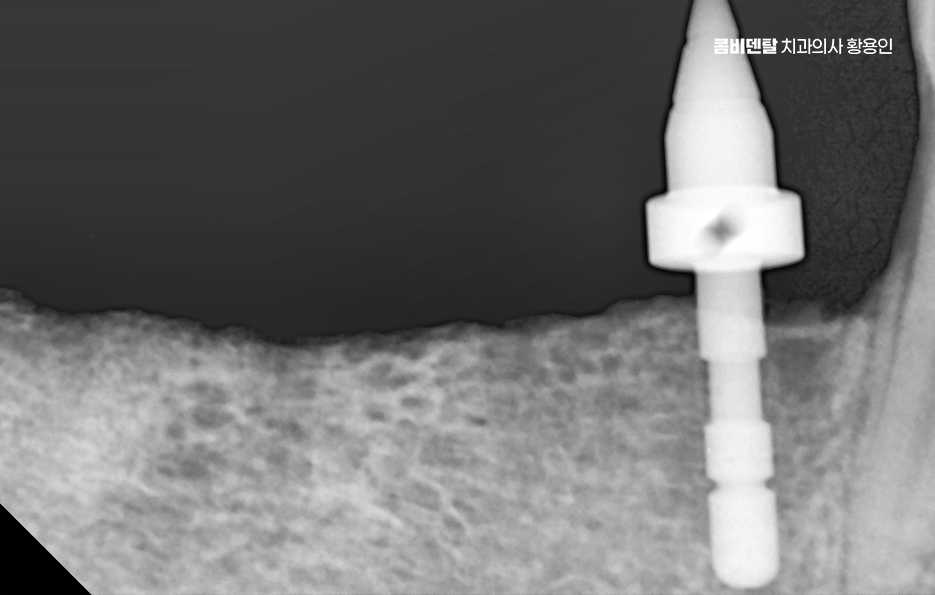 임플란트 뼈이식 안하면 어떤 문제가 있는거죠 관련 이미지 2