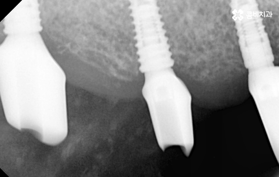 임플란트 나이 얼마나 영향을 줄까 관련 이미지 8