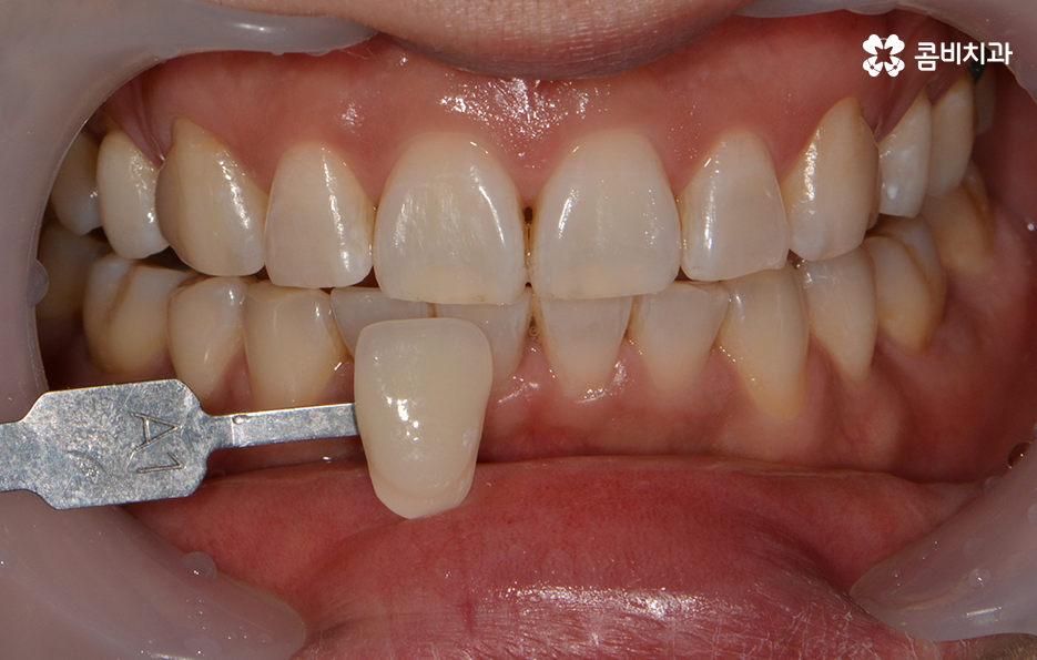 치과미백치료 누런 이가 고민되신다면 관련 이미지 7