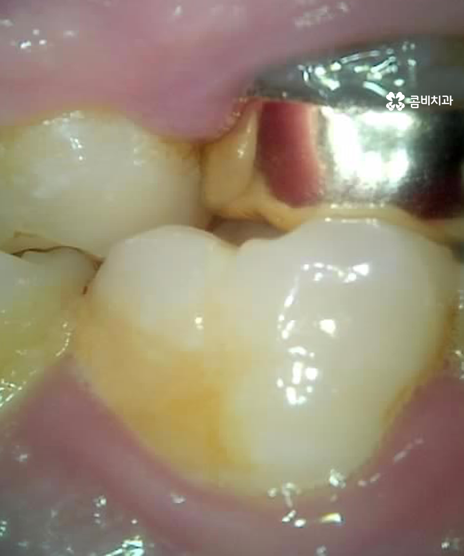 레진 인레이 치료 후 2차충치 왜 발생하고 어떻게 대처할까 관련 이미지 7
