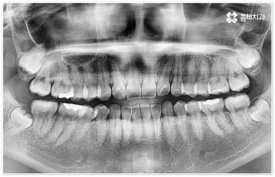 앞니부분교정 누구나 할수있나요? 관련 이미지 2