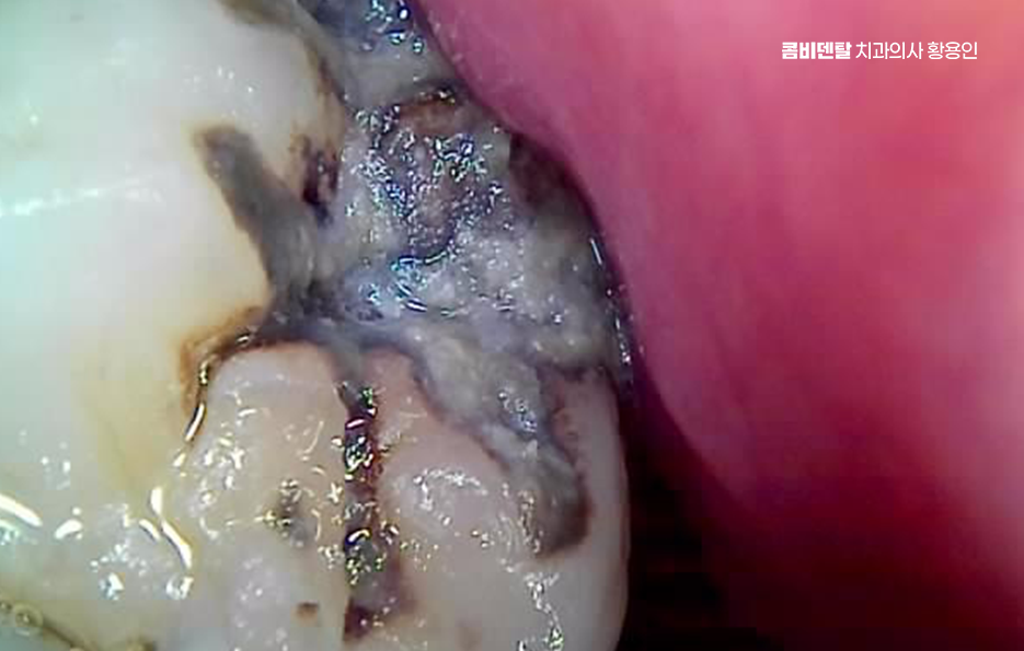 치아 시림 통증 갈수록 심해지다면 관련 이미지 2