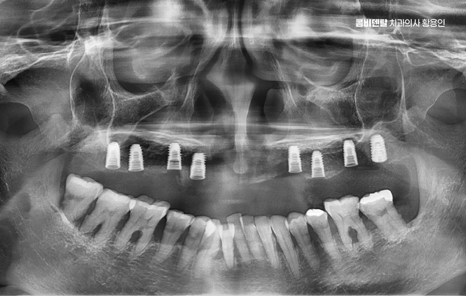 If You’re Considering Full Upper-Arch Implants for the Long Term image 4