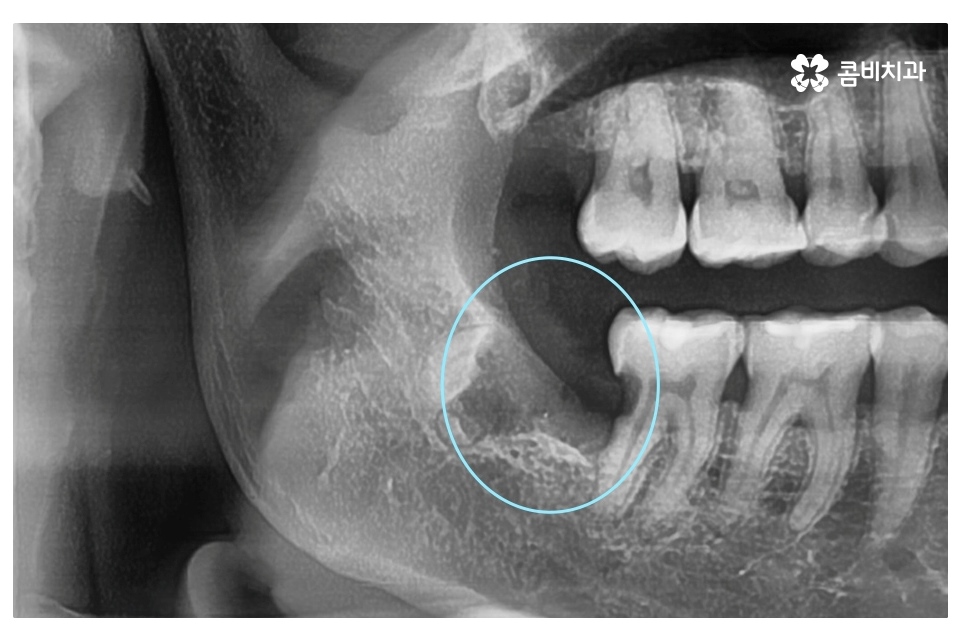 누운 사랑니 발치와 어금니신경치료를 하게 된 사례 관련 이미지 5