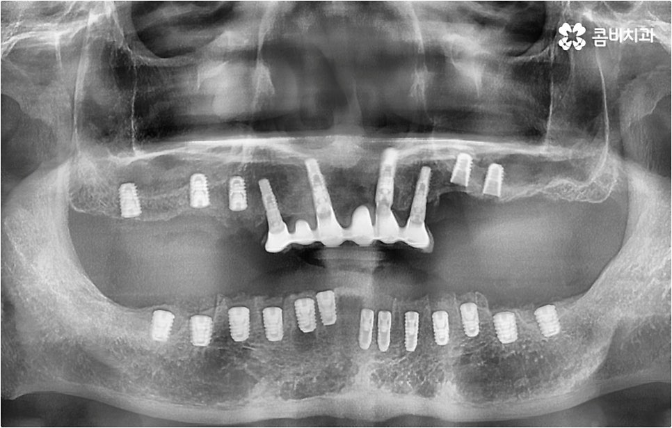 전악임플란트 고려할 사항들은 관련 이미지 13