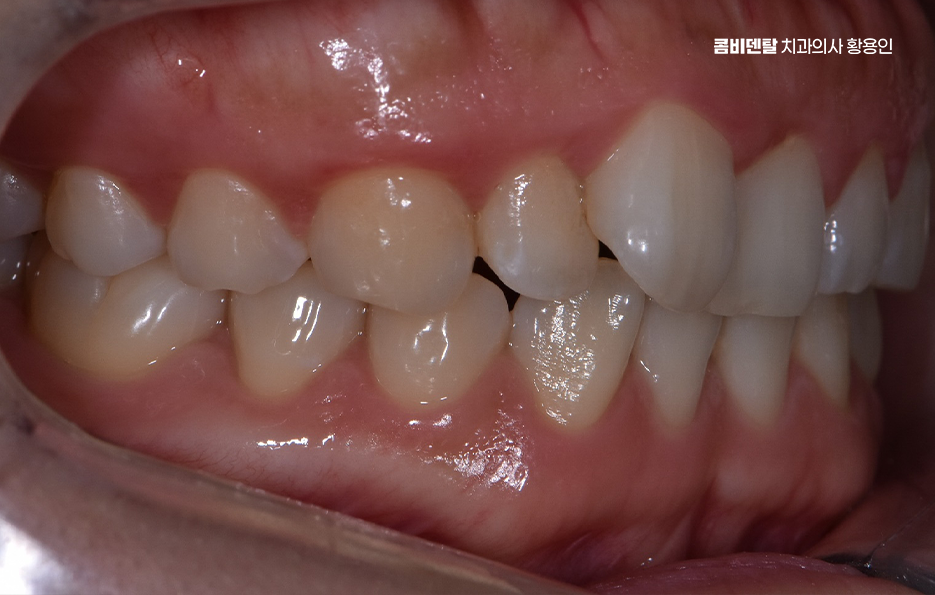 치아교정 통증 줄이는 방법 어떻게 가능할까요 관련 이미지 4