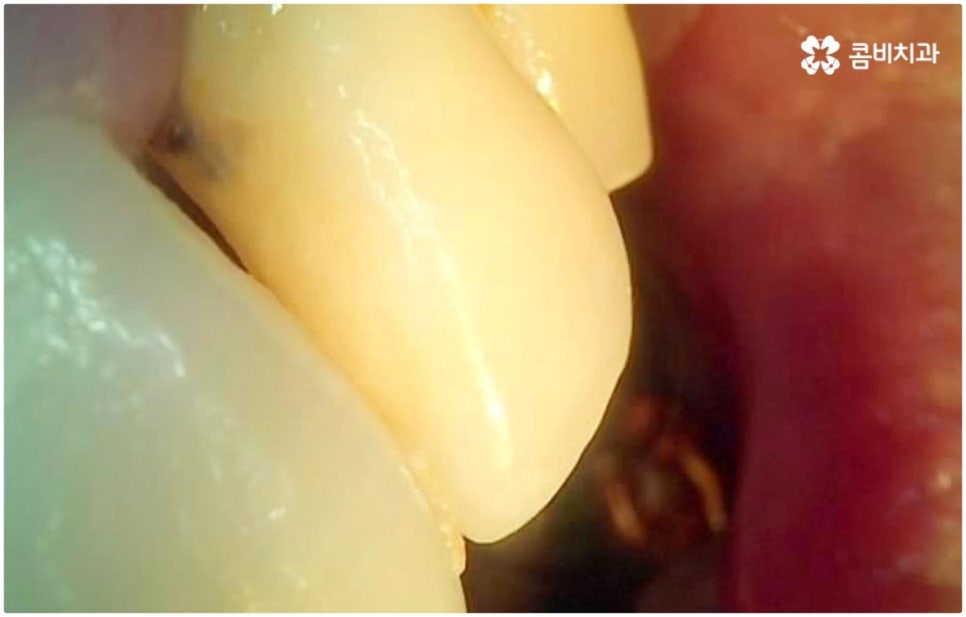 발치후 임플란트 바로 되나요? 관련 이미지 7