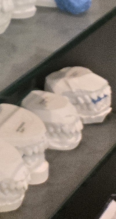 사랑니 주변 잇몸 통증 지금부터가 중요하니까 관련 이미지 50