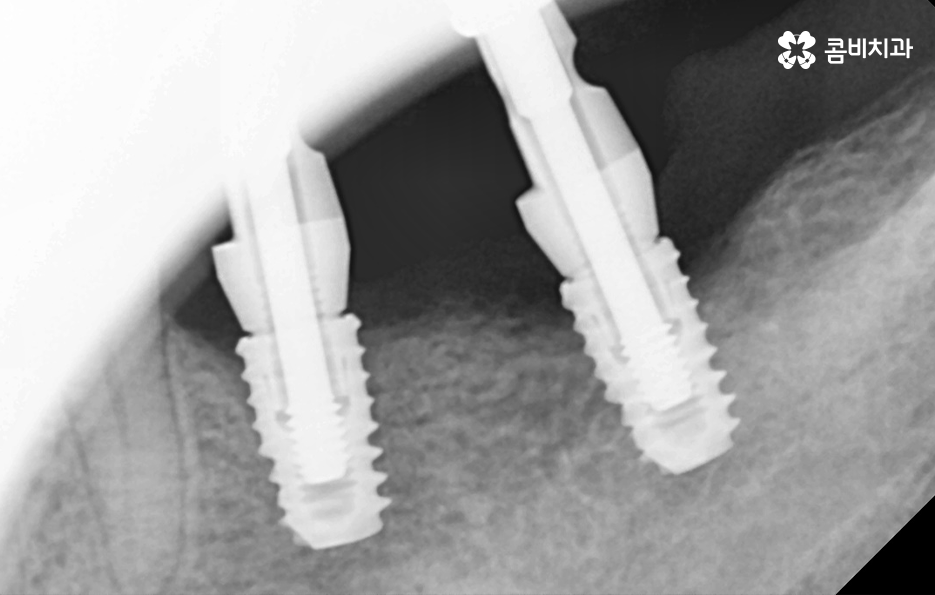 임플란트 해야 하는데 치아교정이 하고 싶다면 관련 이미지 9