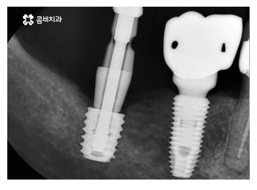 임플란트 기간 케이스에 따라 달라진다면 관련 이미지 4