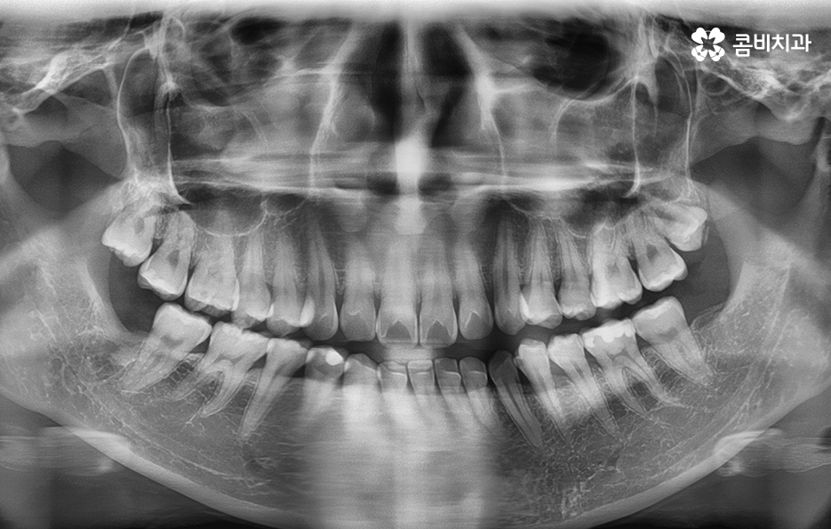 앞니치아교정 자연스러운 결과를 위해 알아둬야 할 점 관련 이미지 5