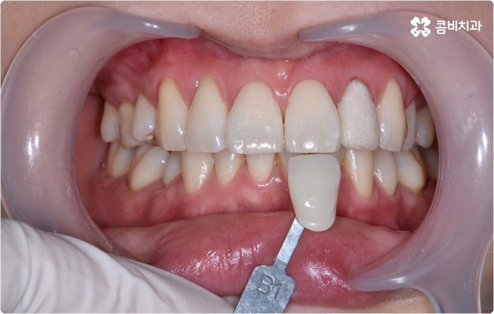 치아미백시술 관심있다면 관련 이미지 9