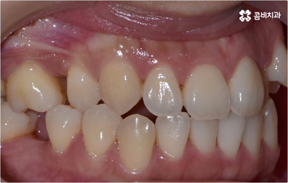 치아설측교정 보이지않아 좋아요 관련 이미지 6