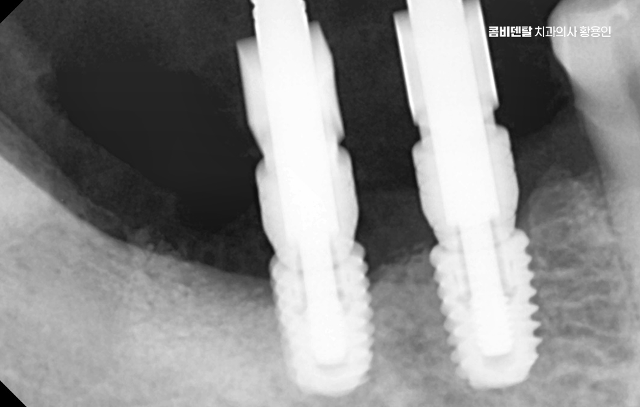 임플란트의 장점 할까 말까 고민이신 분들을 위한 정리 관련 이미지 4