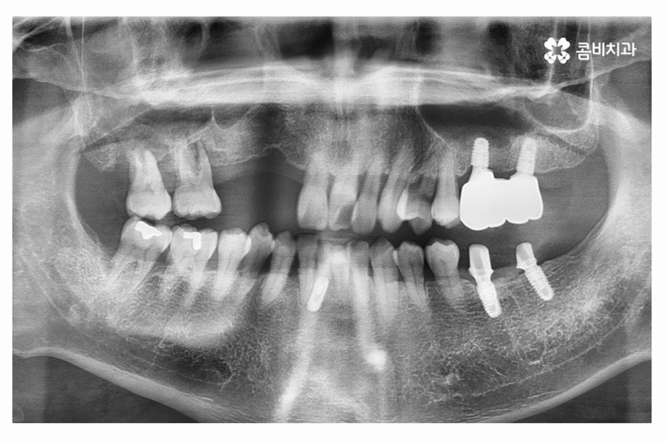 임플란트 수술 신중하게 결정하려면 관련 이미지 5