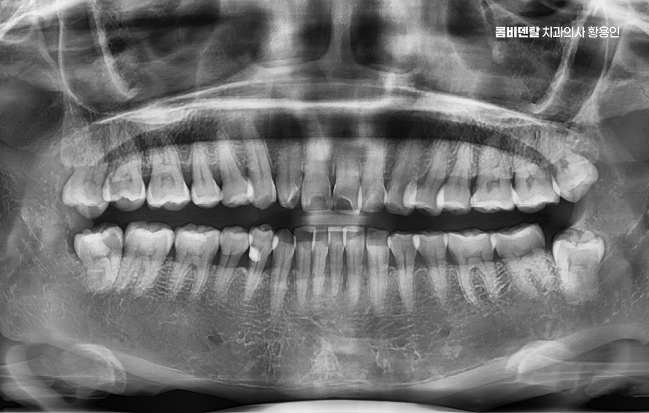 아래 사랑니 발치 통증 미리 알고 대처하려면 관련 이미지 1