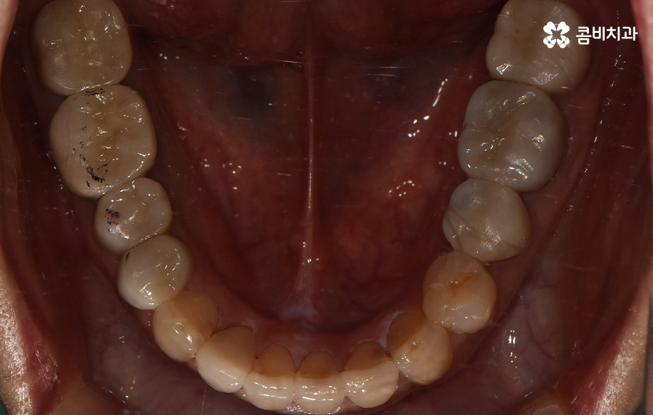 아래 앞니깨짐 치료 감쪽같이 해결하려면 관련 이미지 10