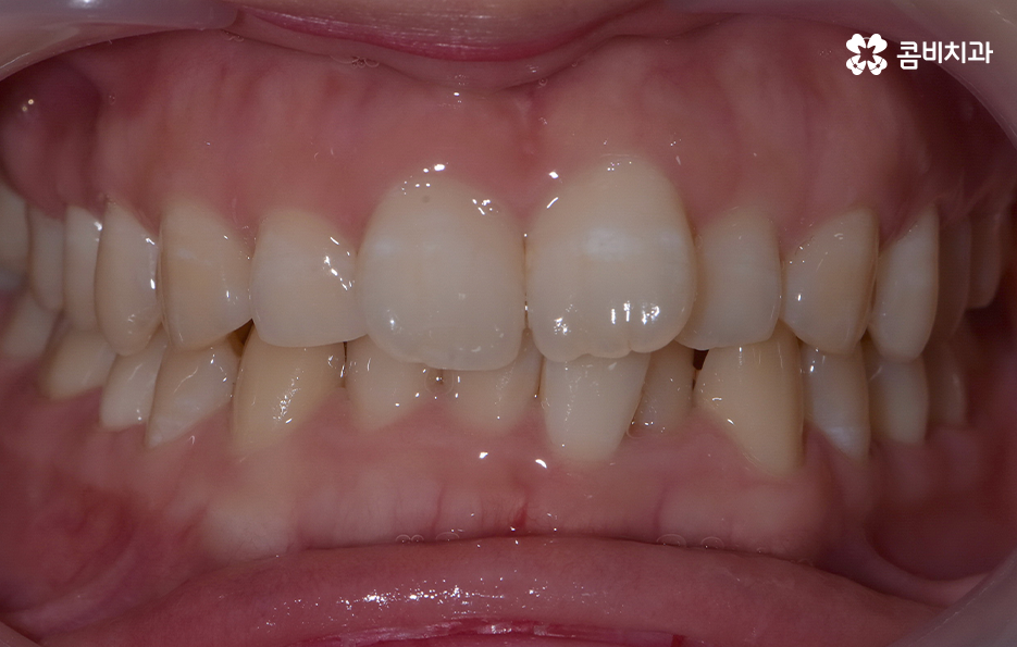 앞니 틀어짐 교정으로 해결하면 될까요 관련 이미지 1