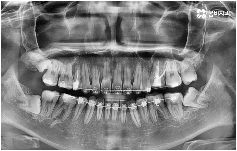매복사랑니발치치과 어디로 가나요? 관련 이미지 7