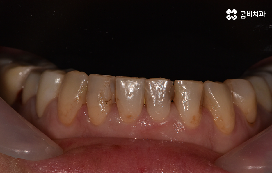 아래 앞니깨짐 치료 감쪽같이 해결하려면 관련 이미지 3