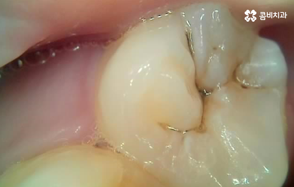 어금니 레진 깨짐 변색 안아파도 이렇게 대처하세요 관련 이미지 5