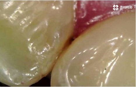 명동치과 타고난 이의 수명은 관련 이미지 6