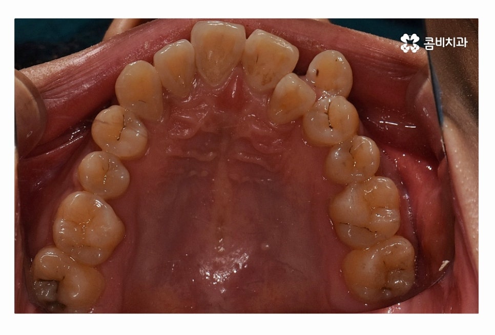 덧니 발치 필수적으로 하는건가요 관련 이미지 5