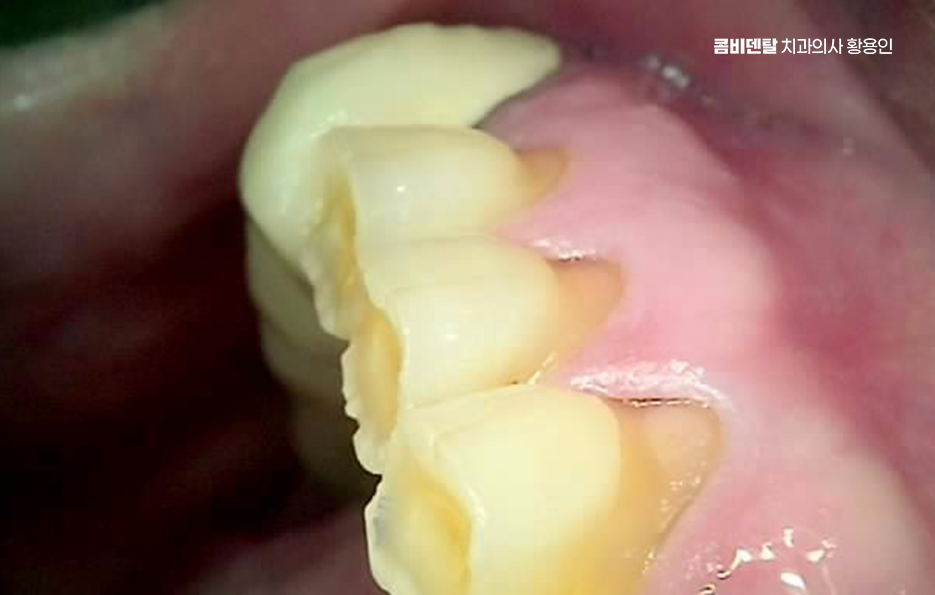 어금니 임플란트 뼈이식 이럴때 해당됩니다 관련 이미지 3