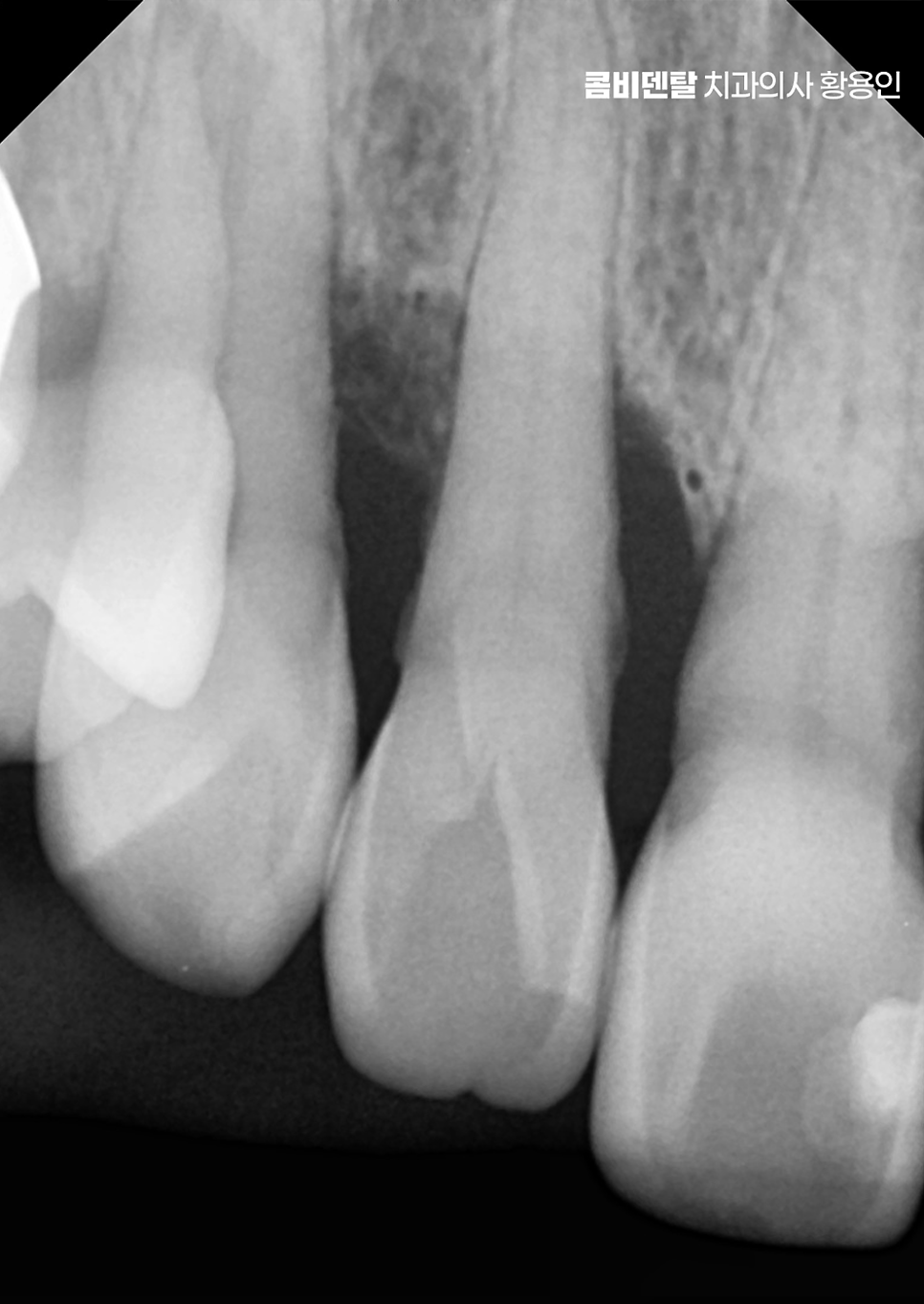 치아 사이 벌어짐 심해지는 이유부터 알아보면 관련 이미지 6