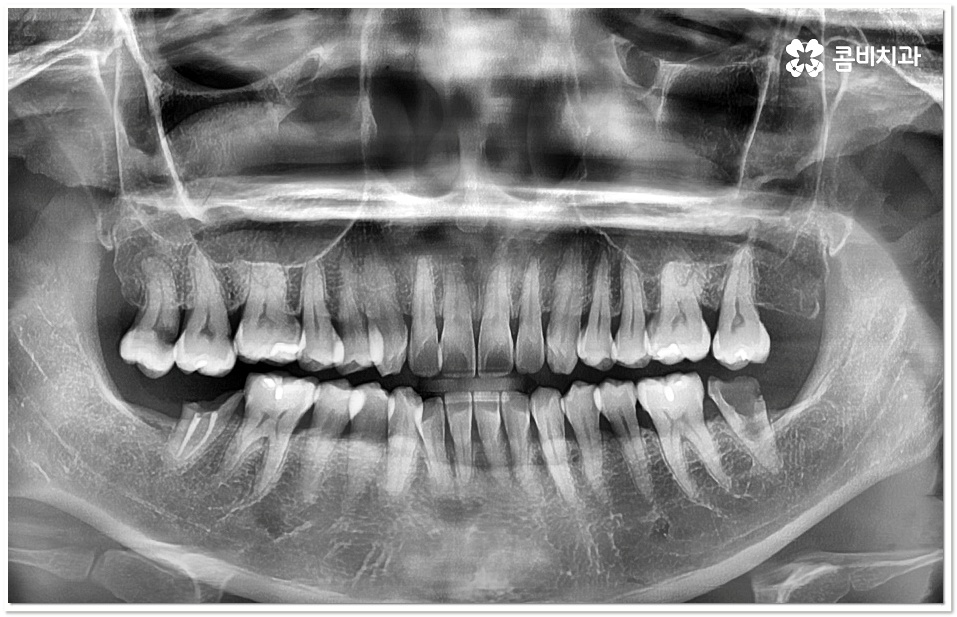 어금니 충치치료 빠를수록 좋아요 관련 이미지 3