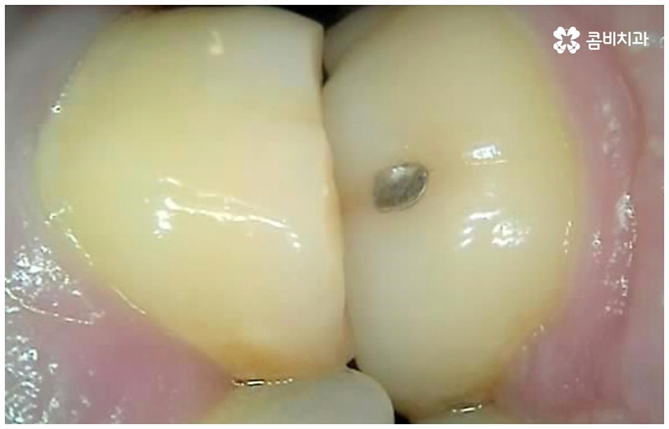 어금니신경치료 케이스마다 달라요 관련 이미지 2