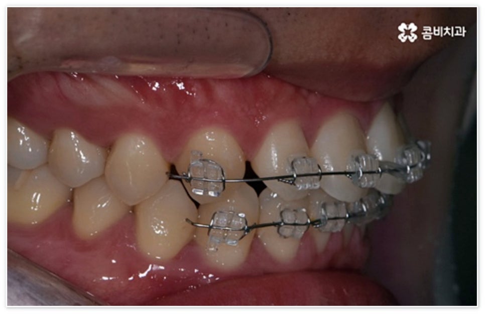 앞니 벌어짐 고치고 싶어요 관련 이미지 6