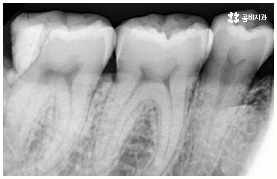 어금니 사이 충치 빠르게 대응해야 관련 이미지 6