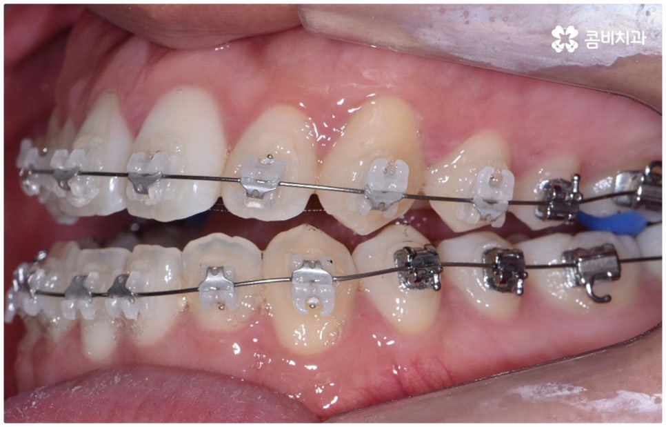 부정교합 3급 왜 고쳐야 하나요 관련 이미지 9
