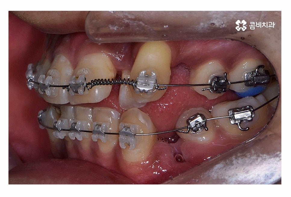 덧니 발치 필수적으로 하는건가요 관련 이미지 9