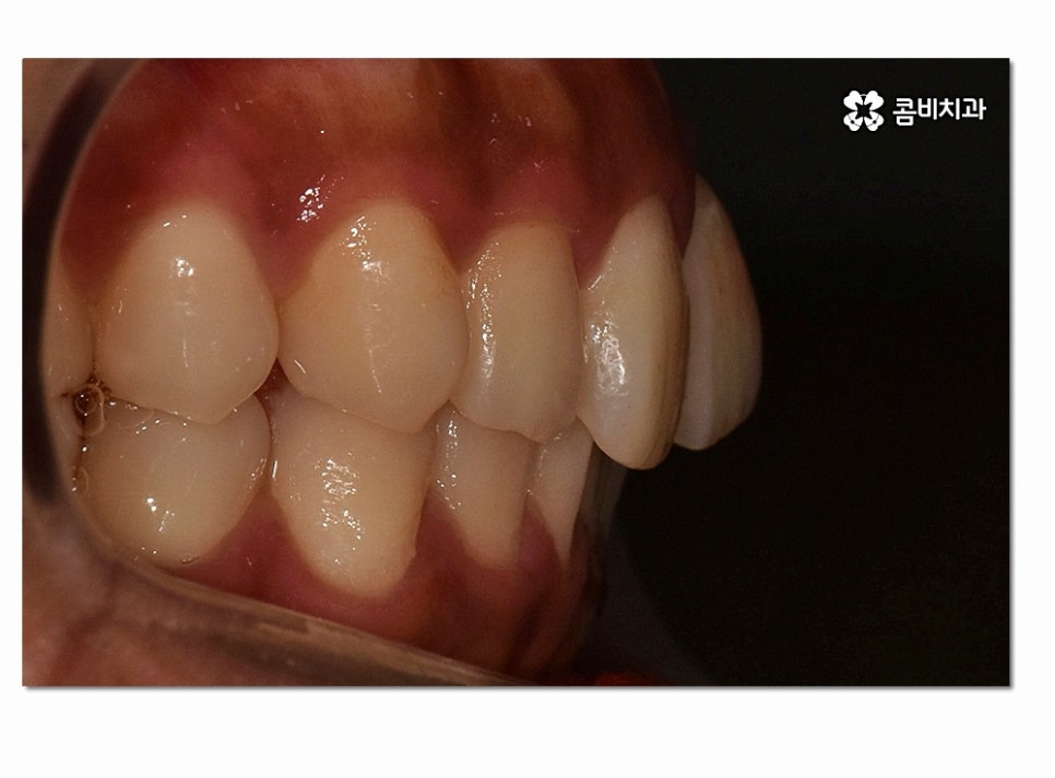 앞니 부분교정 오래 걸리지 않고 원하는 부위만 관련 이미지 3