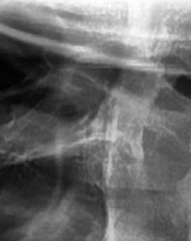 어금니 뒤 잇몸 부음 어떤 문제길래 이런거죠 관련 이미지 15