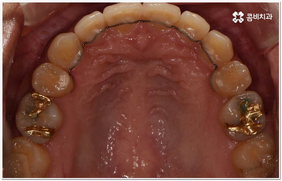 돌출입교정치과 알아보는 기준은 관련 이미지 16