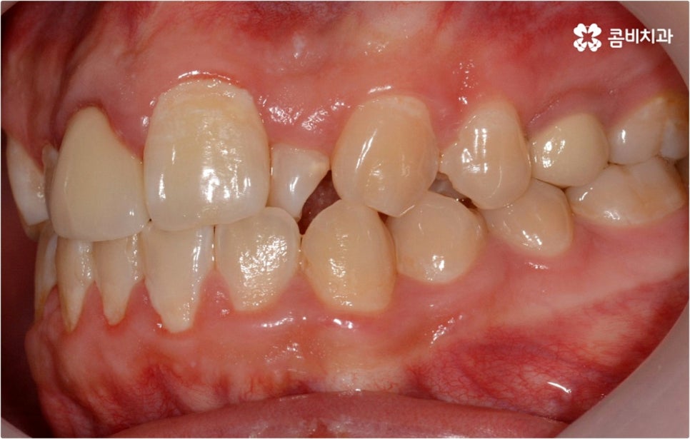 덧니교정 하고싶다면 관련 이미지 3