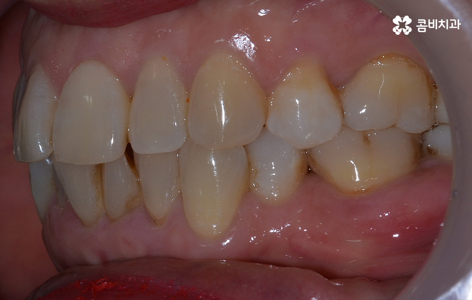 돌출입 콤비교정으로 얼굴까지 개선하는 방법은 관련 이미지 4