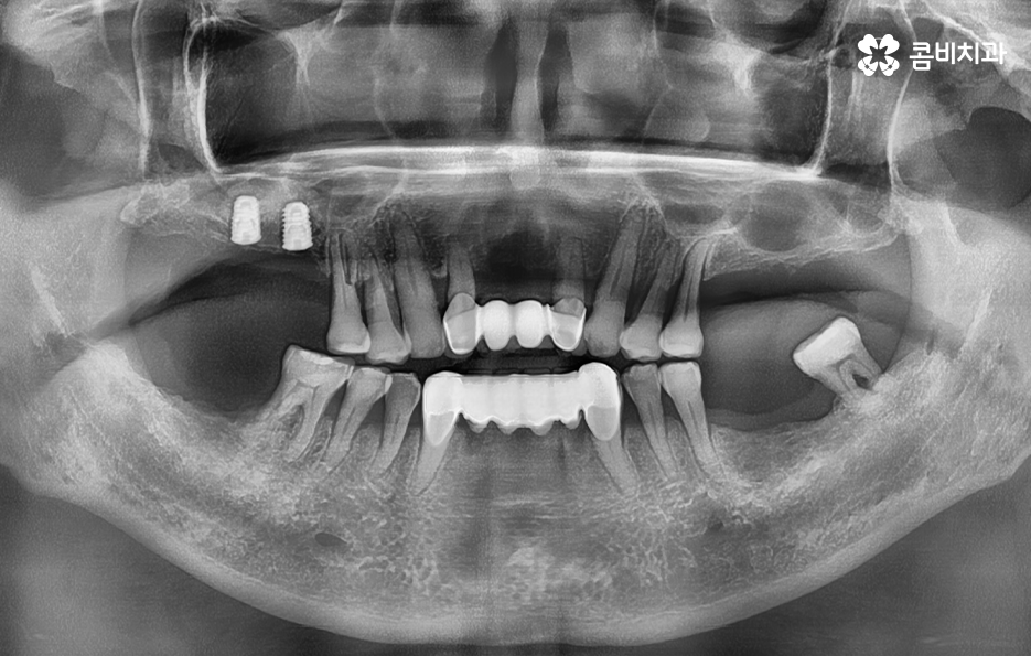 50대임플란트 각별하게 주의해야 하는 시기 관련 이미지 6