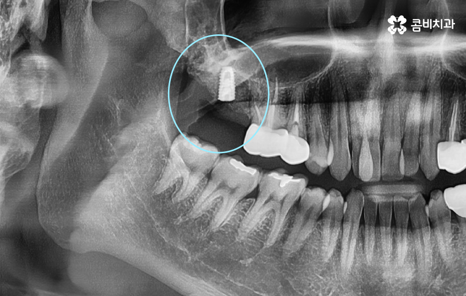 어금니 충치 발치 결국 뽑아야 할때와 살릴 수 있는 케이스 관련 이미지 5