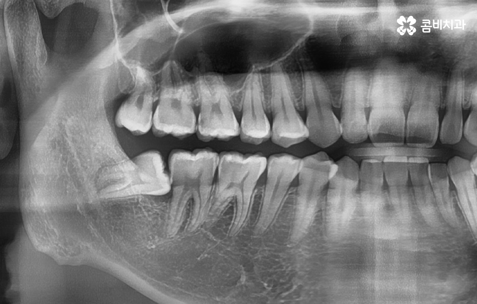 부분매복 사랑니 발치 신중하게 대비하려면 관련 이미지 2