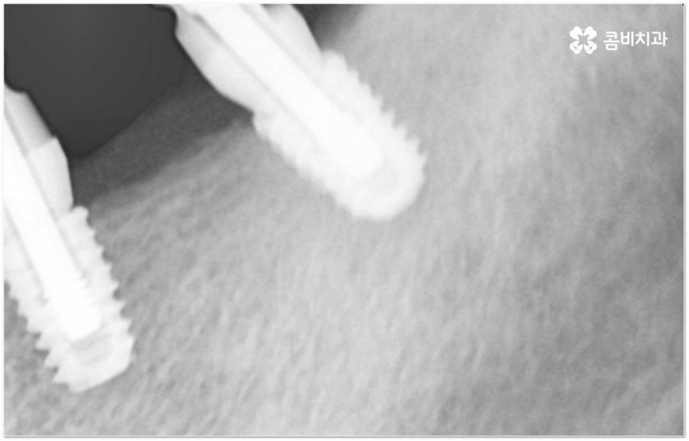 뼈이식임플란트 언제하나요? 관련 이미지 12