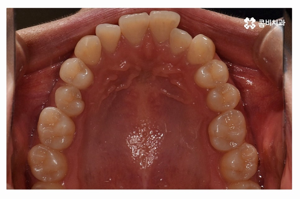 덧니교정 체계적으로 준비하려면 관련 이미지 3