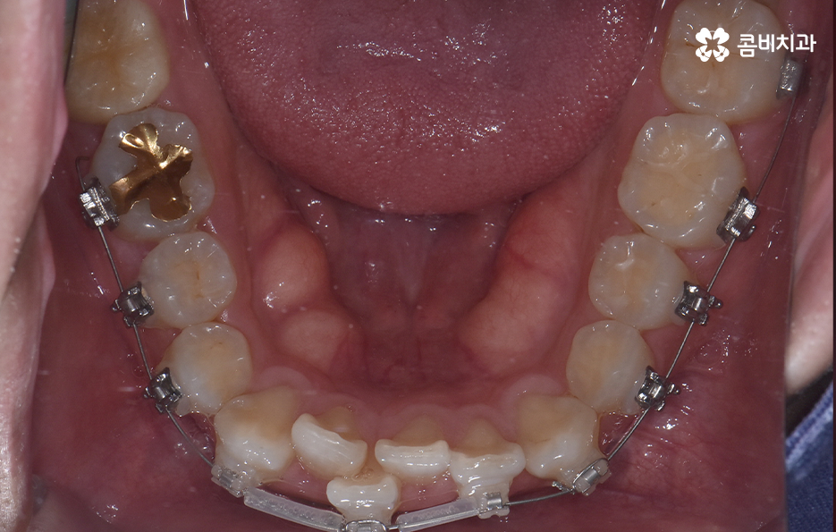 아랫니교정 이렇게만 파악하시면 됩니다 관련 이미지 11