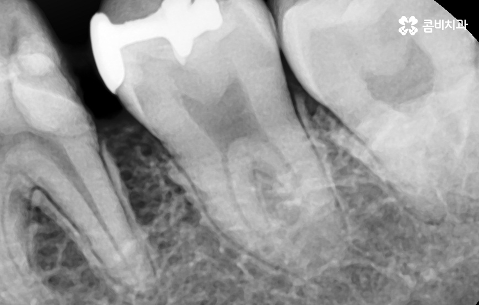 치아 사이 충치 까다로운 이유부터 알아보시죠 관련 이미지 4